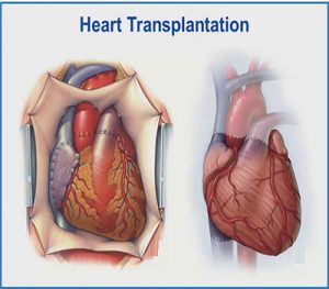 Heart Transplant Surgeon in thane