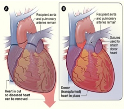 Heart –Lung transplants - Dr. Pravin Kulkarni