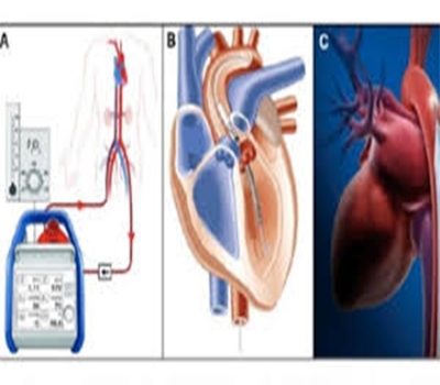 Mechanical Circulatory Support – Dr. Pravin Kulkarni